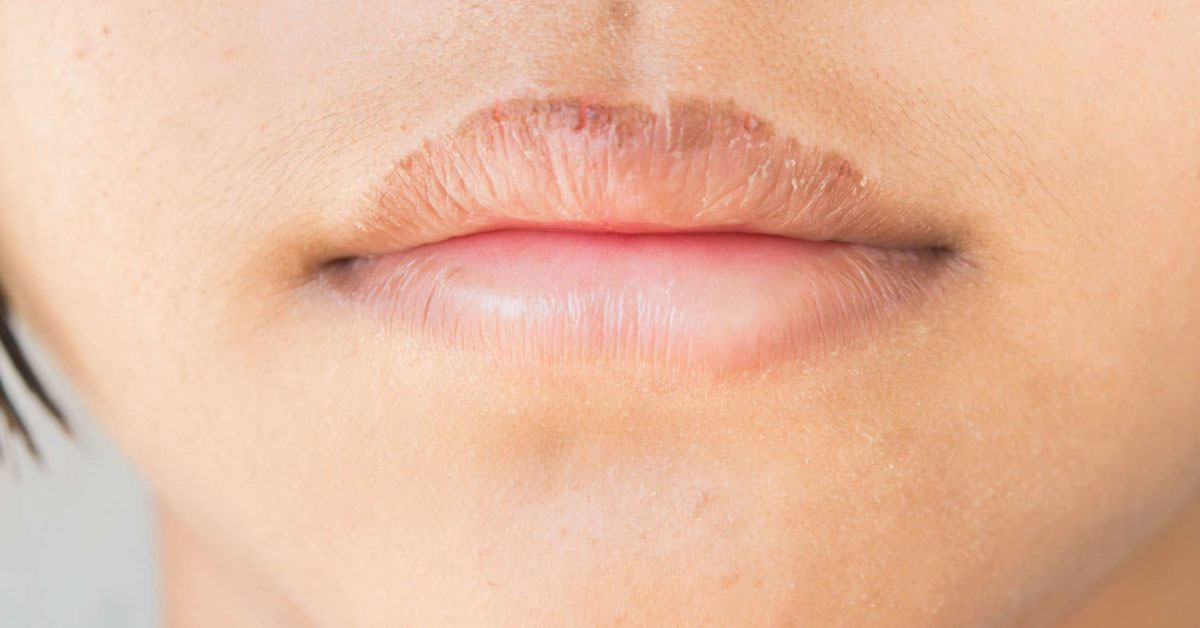 Home remedies to prevent dry and cracked lips