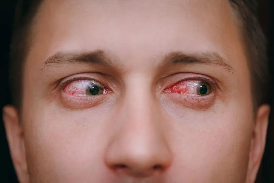 Symptoms and treatment of red eye