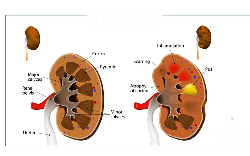 Symptoms and solutions of urinary tract infections