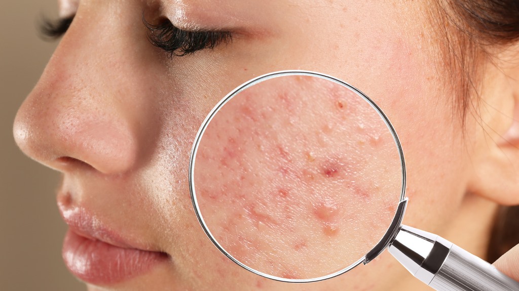 There are many cool ways to get manage of acne at home