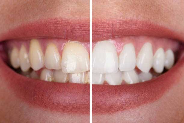 Tips to get rid of yellow teeth