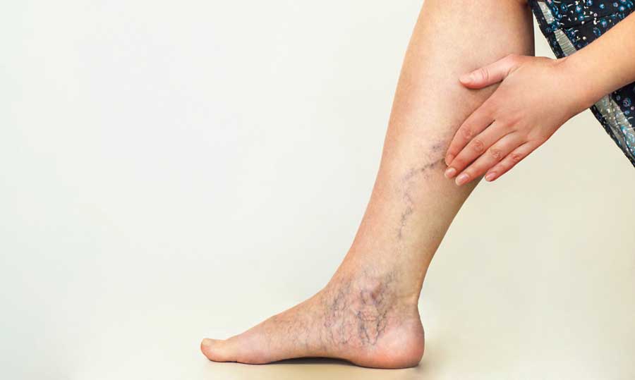 Try these natural remedies for varicose veins