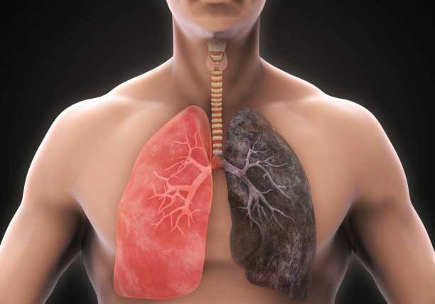 Tuberculosis; Proper treatment and disease control are important