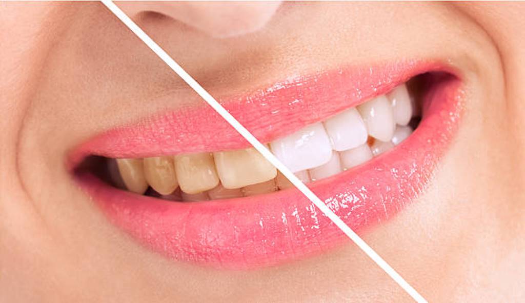 Yellow Teeth: Here are some home remedies