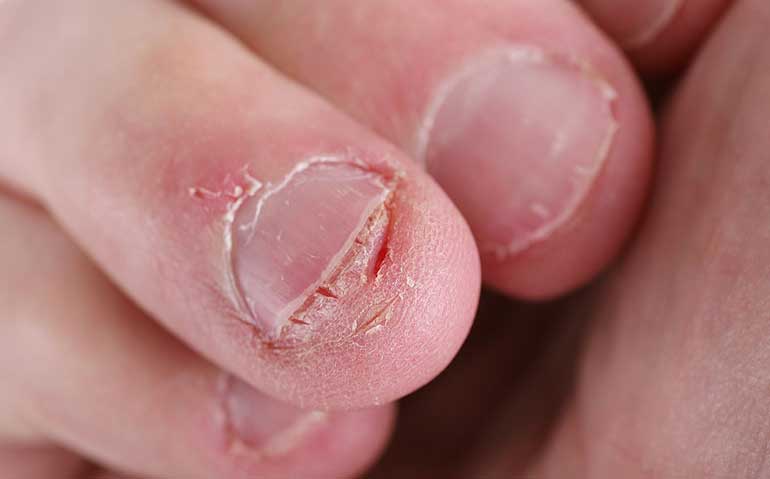Nail biting can lead to serious health issues; How to avoid?