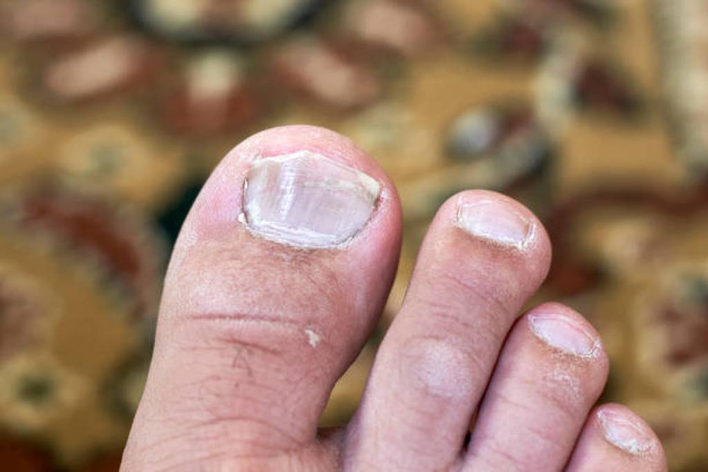 Is the toenail a problem? Here is the solution at home