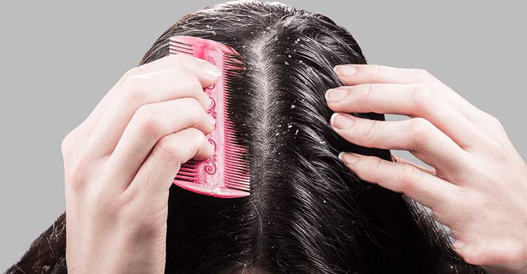Dandruff can be removed using some natural methods