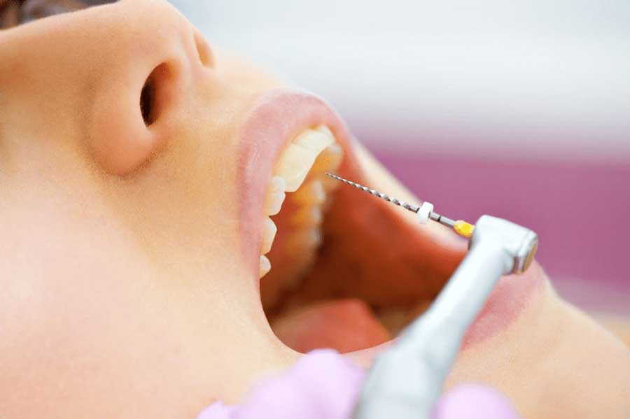 How to avoid your teeth from tooth extraction and root canal