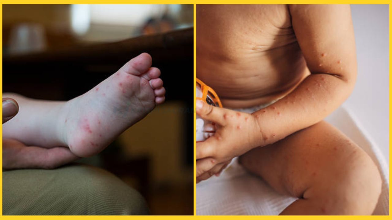 Hand-foot-mouth disease: അഞ്ച് വയസിന് താഴെയുള്ള കുട്ടികളെ ശ്രദ്ധിക്കാം