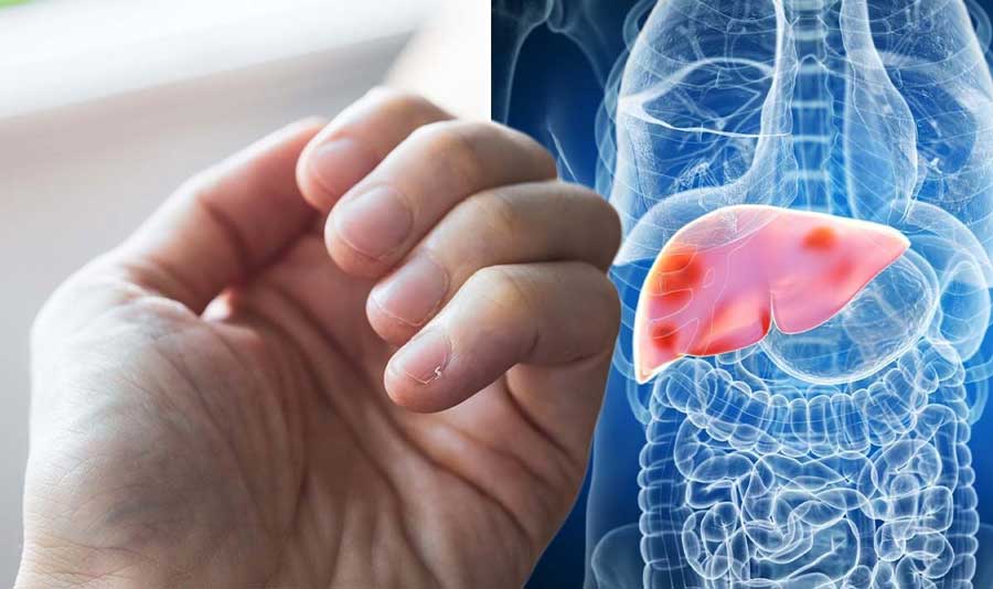 Non-alcoholic fatty liver; Do not ignore these symptoms