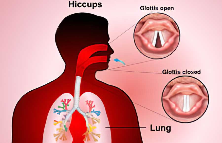 Some effective tips to get rid of the hiccups immediately