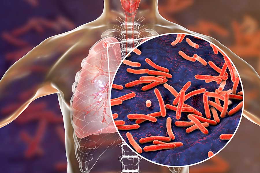 Causes and symptoms of tuberculosis