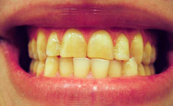 Avoiding these food can prevent yellowing and staining of teeth