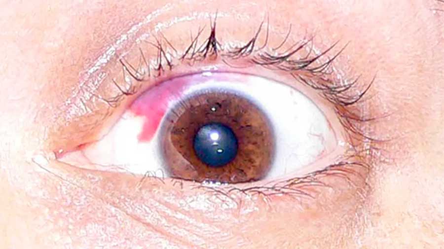 Red spots in the eyes