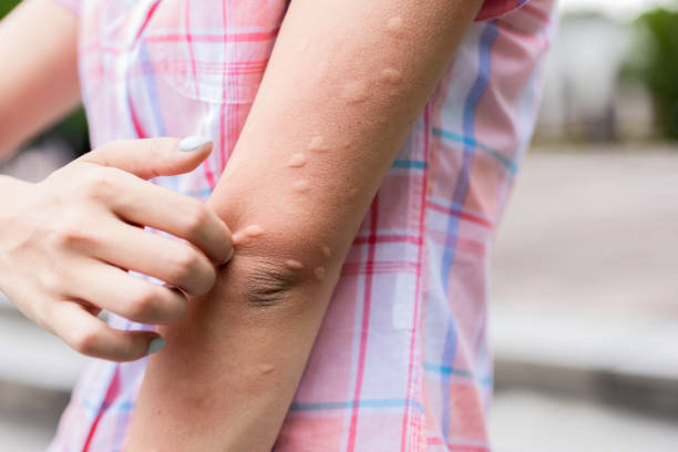 How to prevent itching from mosquito bites