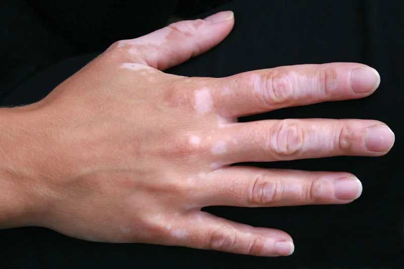 Symptoms and treatment of Vitiligo
