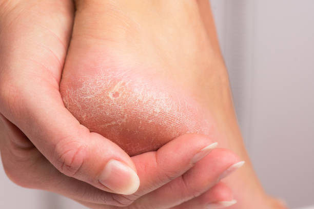 Some natural creams to prevent itchy heels and beauty your feet