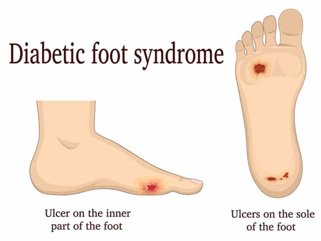 What is Charcot Foot, symptoms and causes