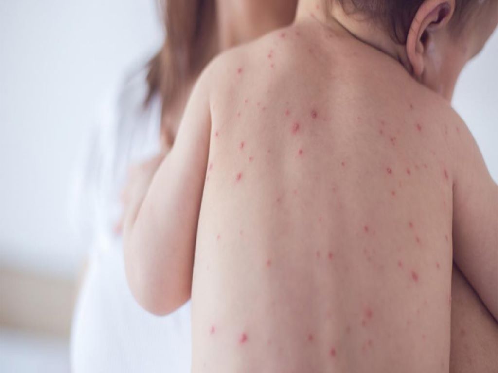 Measles is a contagious disease, especially among children, in which your body feels hot and your skin is covered in small red spots