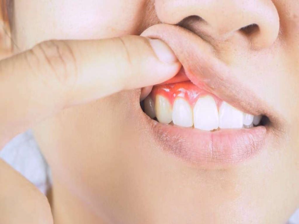 The main cause of bleeding gums is the buildup of plaque at the gum line.