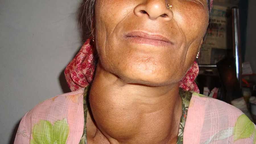 How to identify dangerous and non-dangerous lumps on the neck?