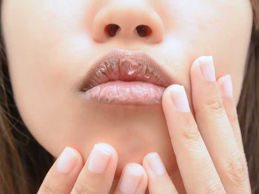 These health issues can make your lips dry