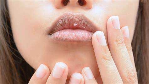 Natural remedies for dry lips