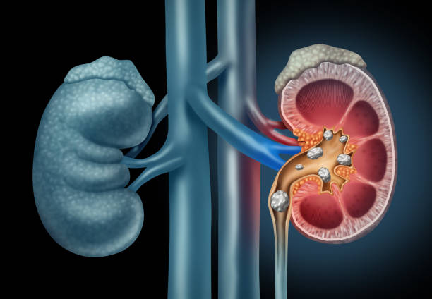 Home made remedies for kidney stone