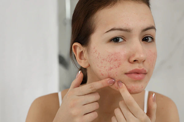How to prevent skin from getting heat rashes in summer