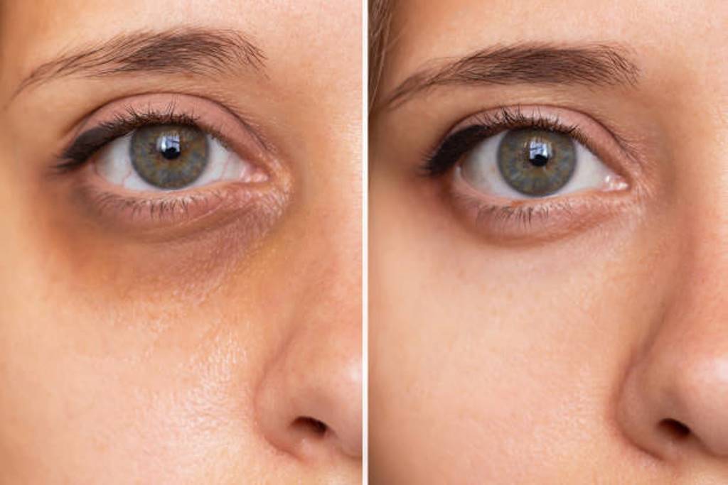 How to reduce Under eye dark circles; Some Tips