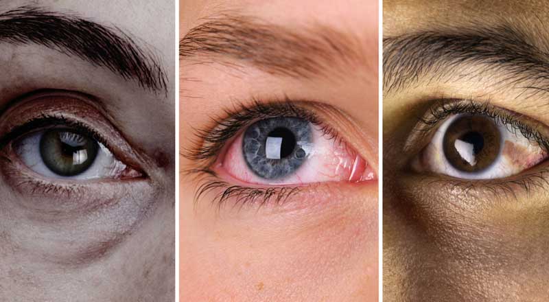 Many diseases can be identified through our eyes; Learn more about this