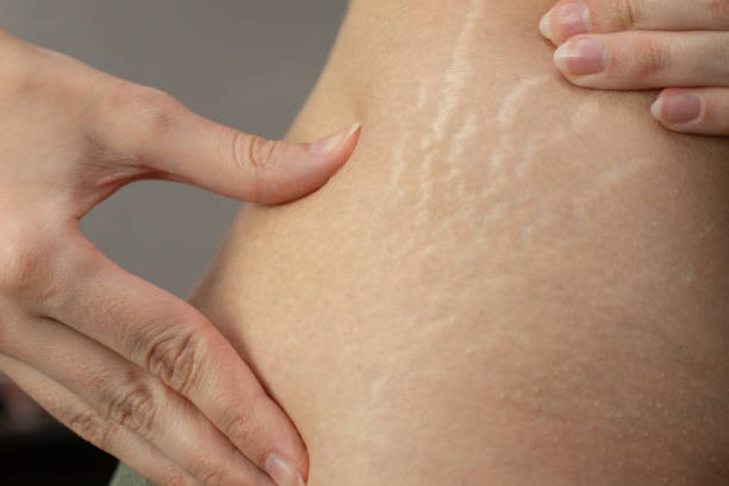 Some tips to get rid of stretch marks on the body