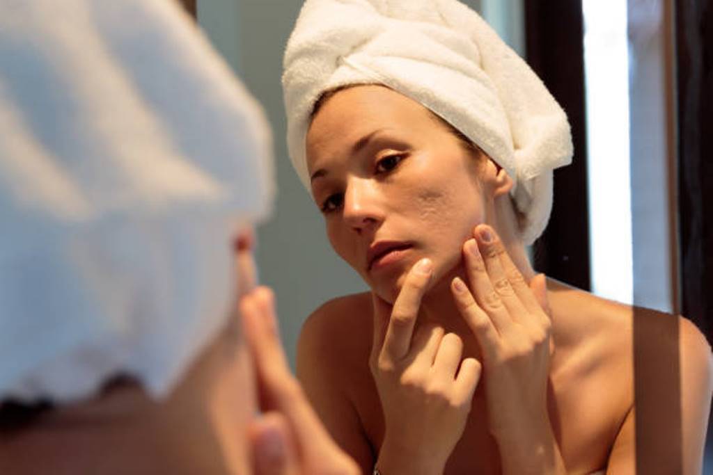 Natural ways to get rid of acne easly
