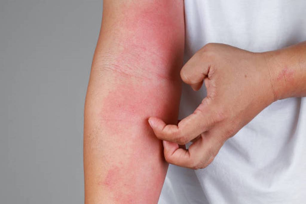 Some home remedies to get rid of itchy skin