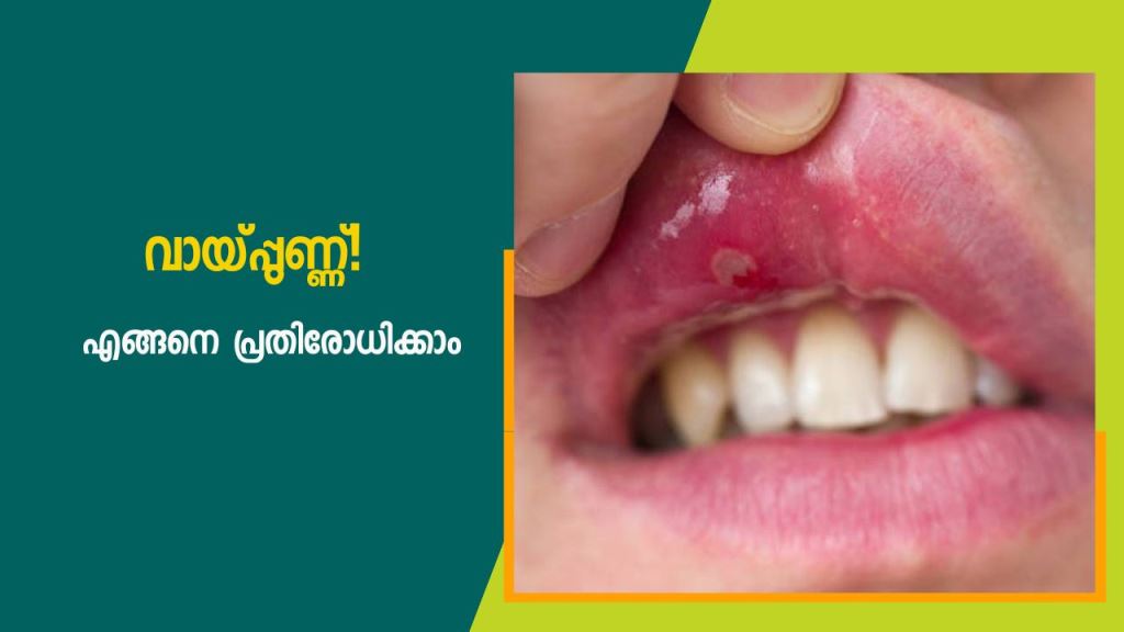 Mouth Ulcer! Some remedies for prevention and pain relief