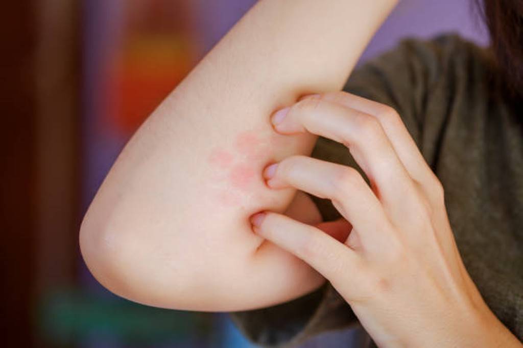 Some home remedies to get rid of ringworm