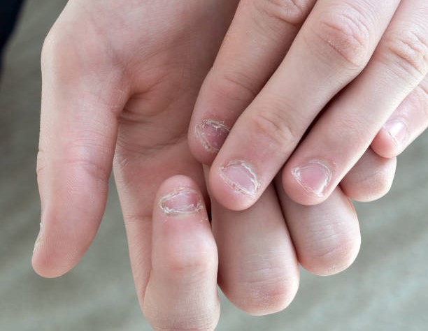 Observe nails to find out diseases