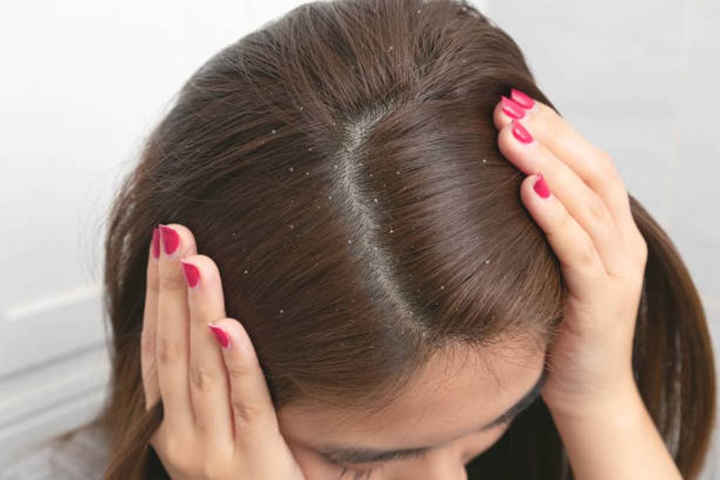 Various Home Remedies to Get Rid of Dandruff