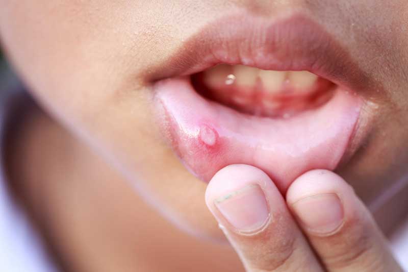 Causes of mouth ulcers and their remedies