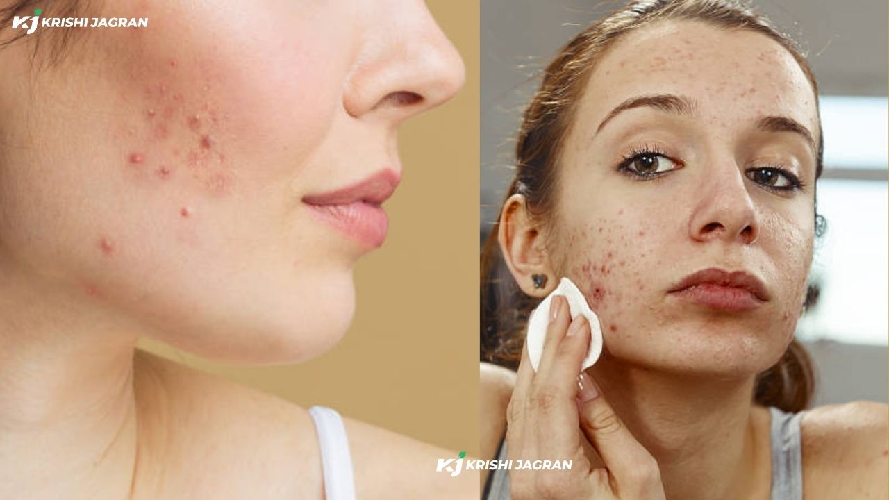 Don't worry about acne! Here are some ways to get rid of it!!!