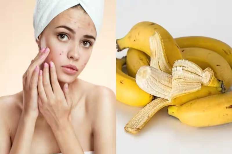Bananas can remove dark spots and acne on the face