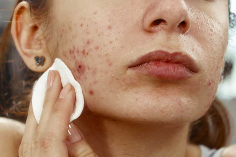 Here are some tips to help to prevent acne breakouts