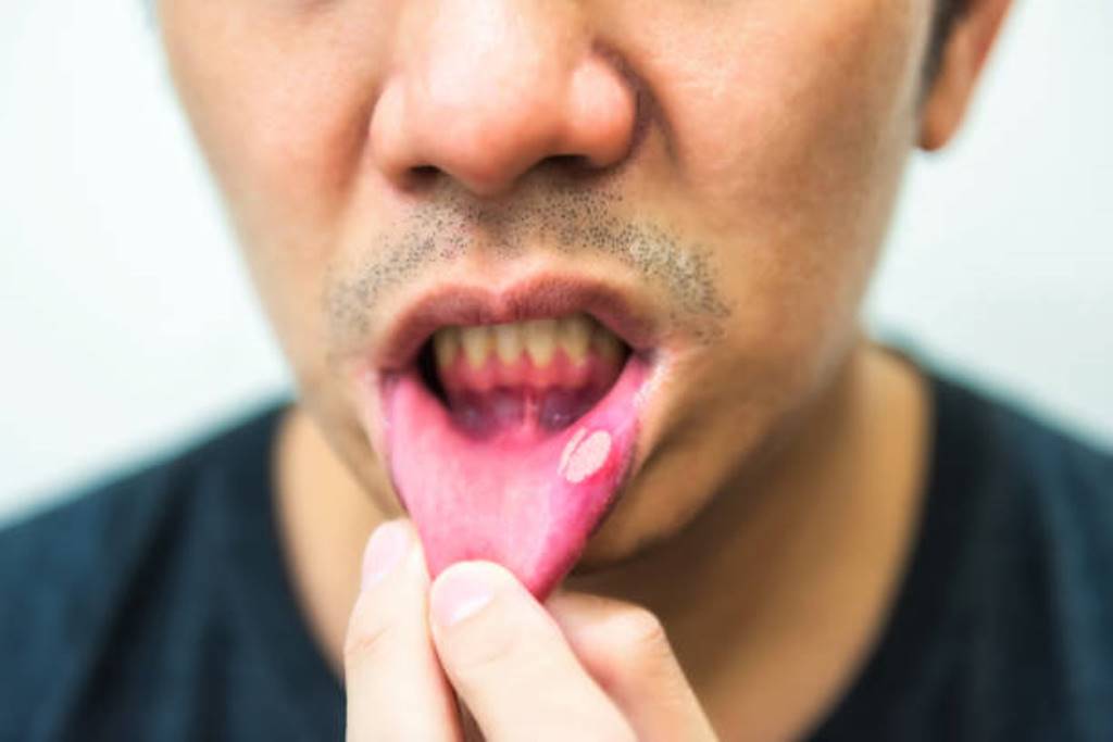 Can you get a mouth ulcer? The solution is at home