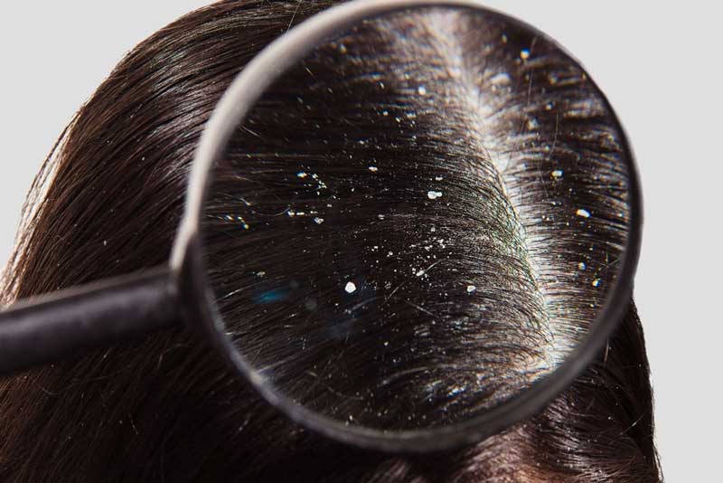 Here are some tips to help you get rid of dandruff easily