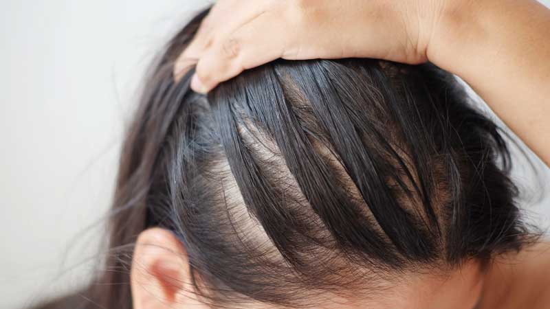 Avoid these food that cause hair loss