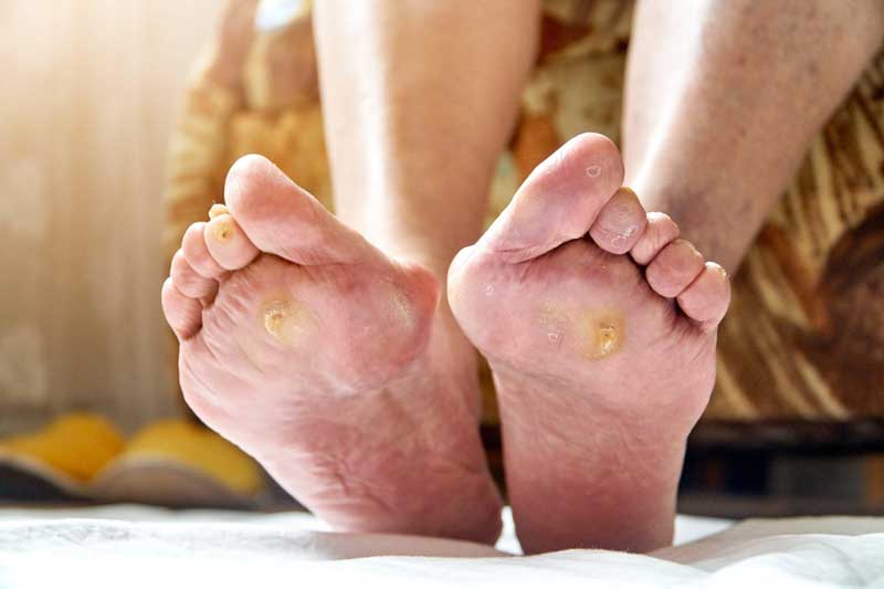 What are the symptoms of diabetic foot?