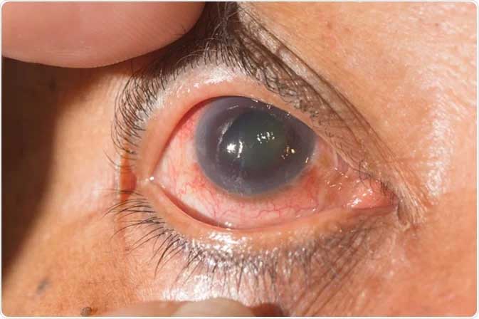 Early Symptoms of Glaucoma that you should know