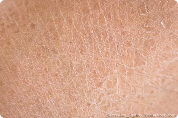 What are the causes of dry skin?