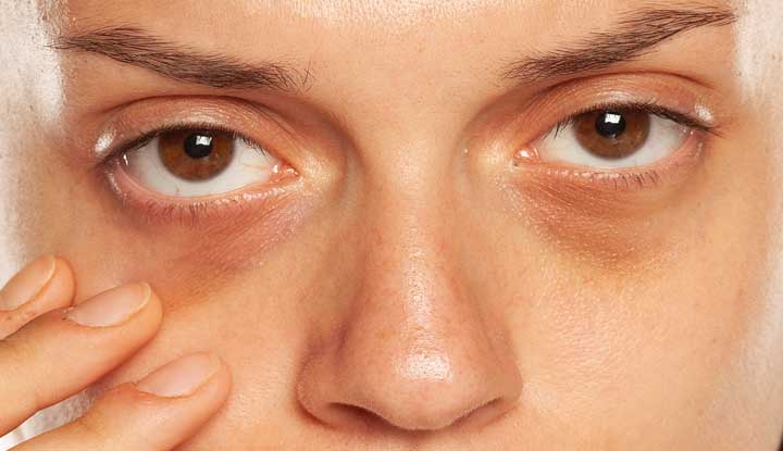 What are the causes of dark circles?