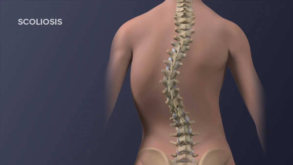 Causes and symptoms of scoliosis